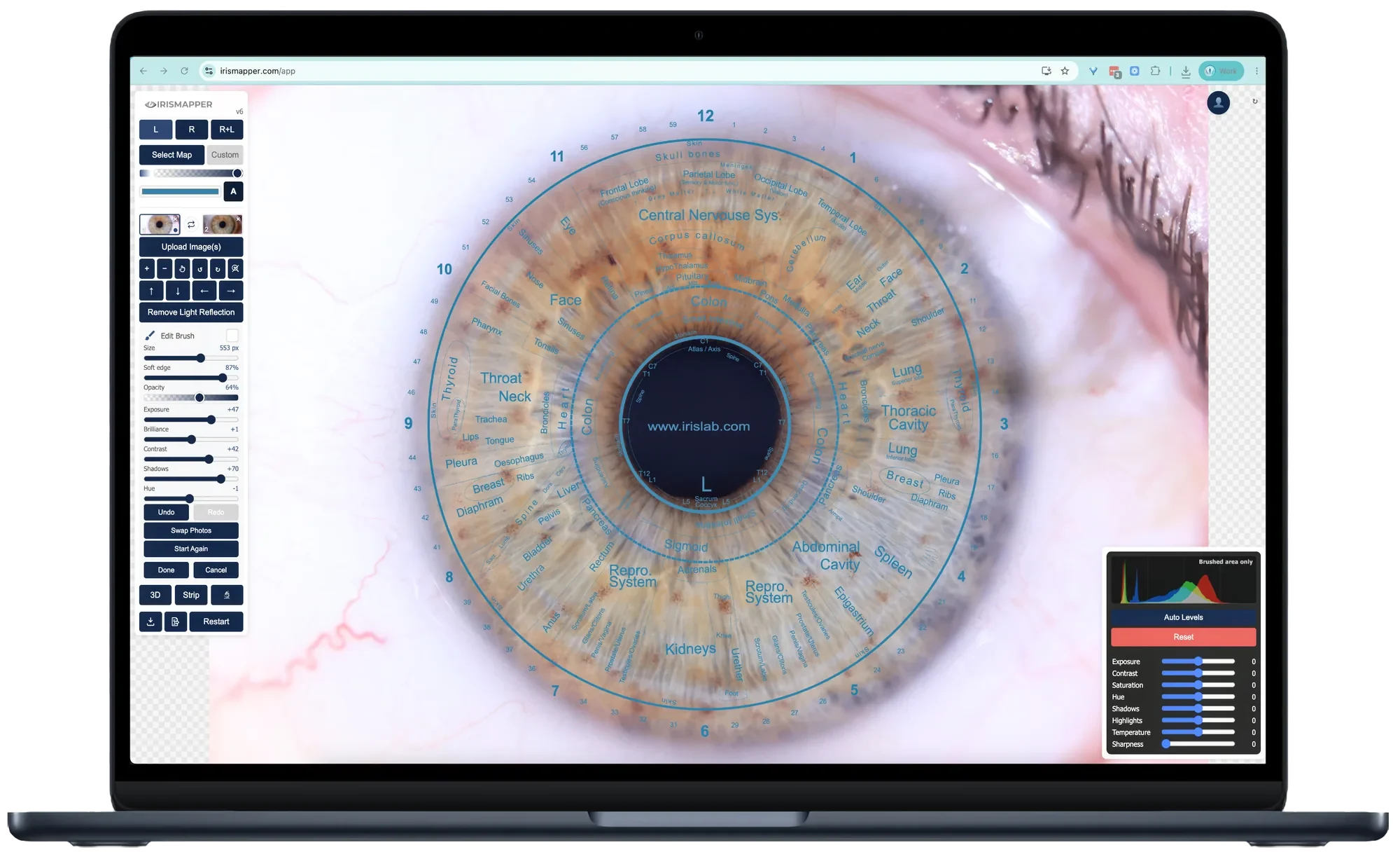 IrisMapper open on a laptop with a labelled iris chart laid over a client's iris: central nervous, throat, neck, thyroid, kidneys