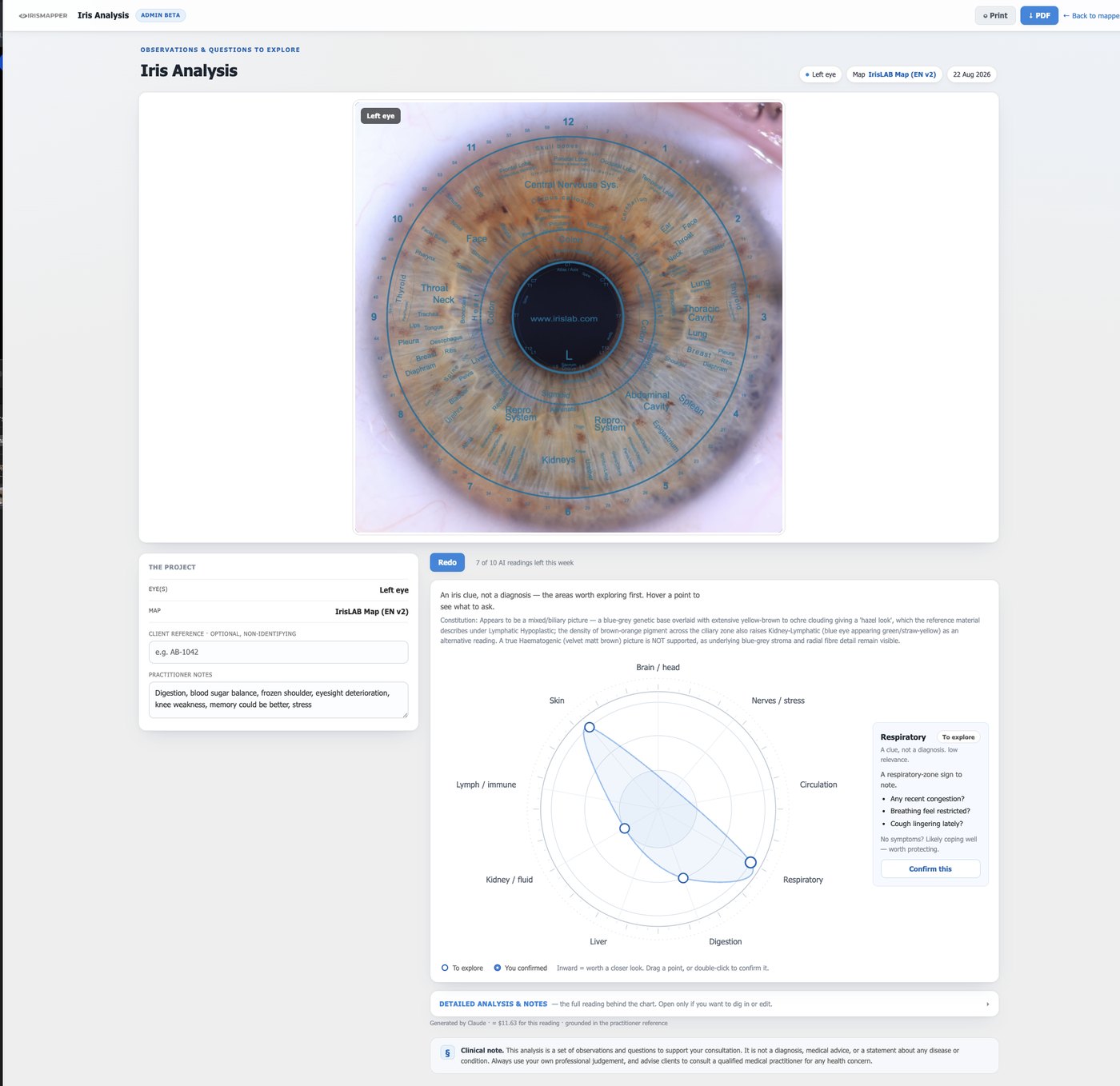 The Iris Analysis page in IrisMapper: the client's left iris with the chart applied, the observations beneath it, and a radar chart of the areas worth exploring