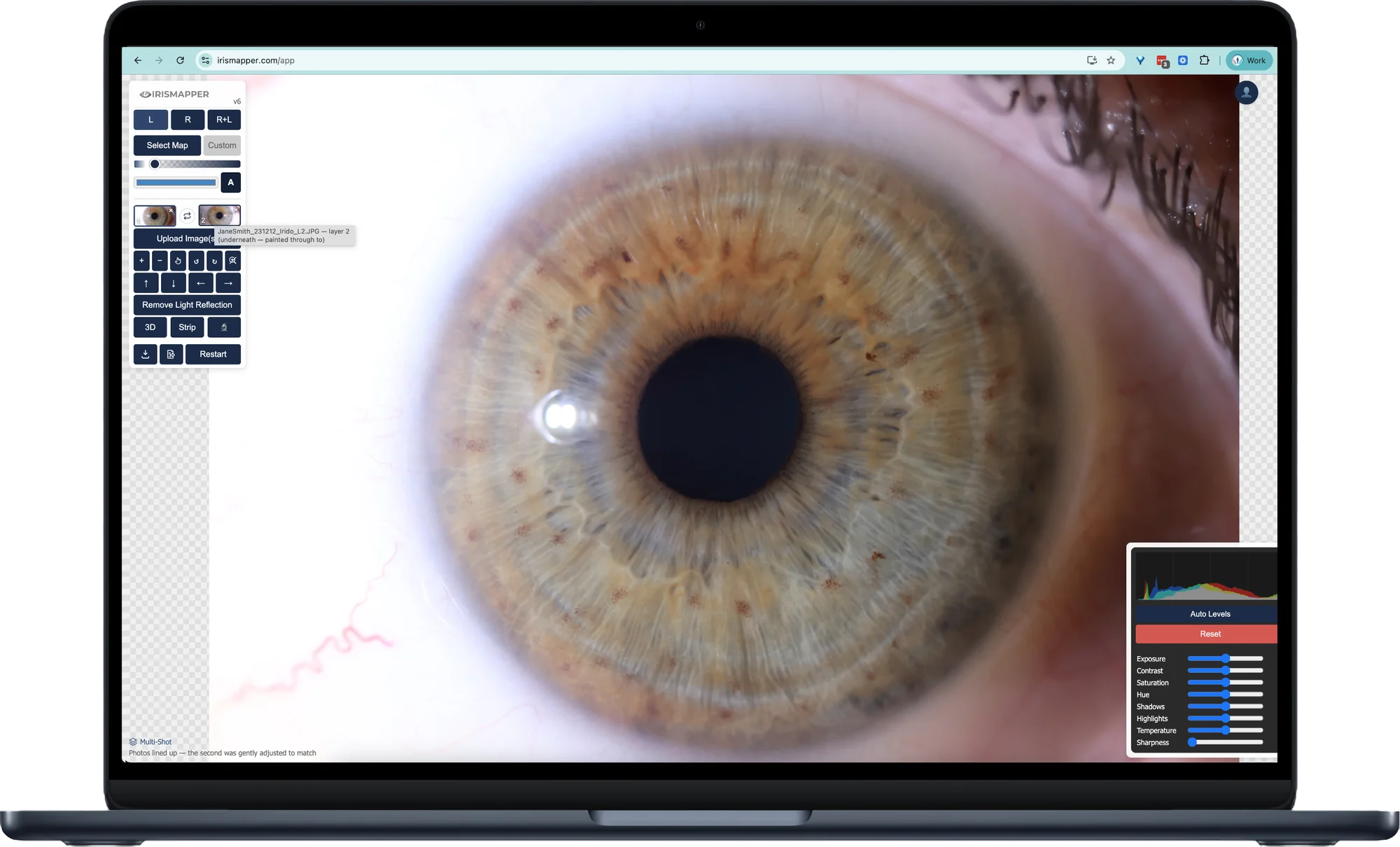 IrisMapper open on a laptop, showing one iris photograph three ways — as the iriscope took it, with the reflections removed and the map aligned, and magnified to check the detail